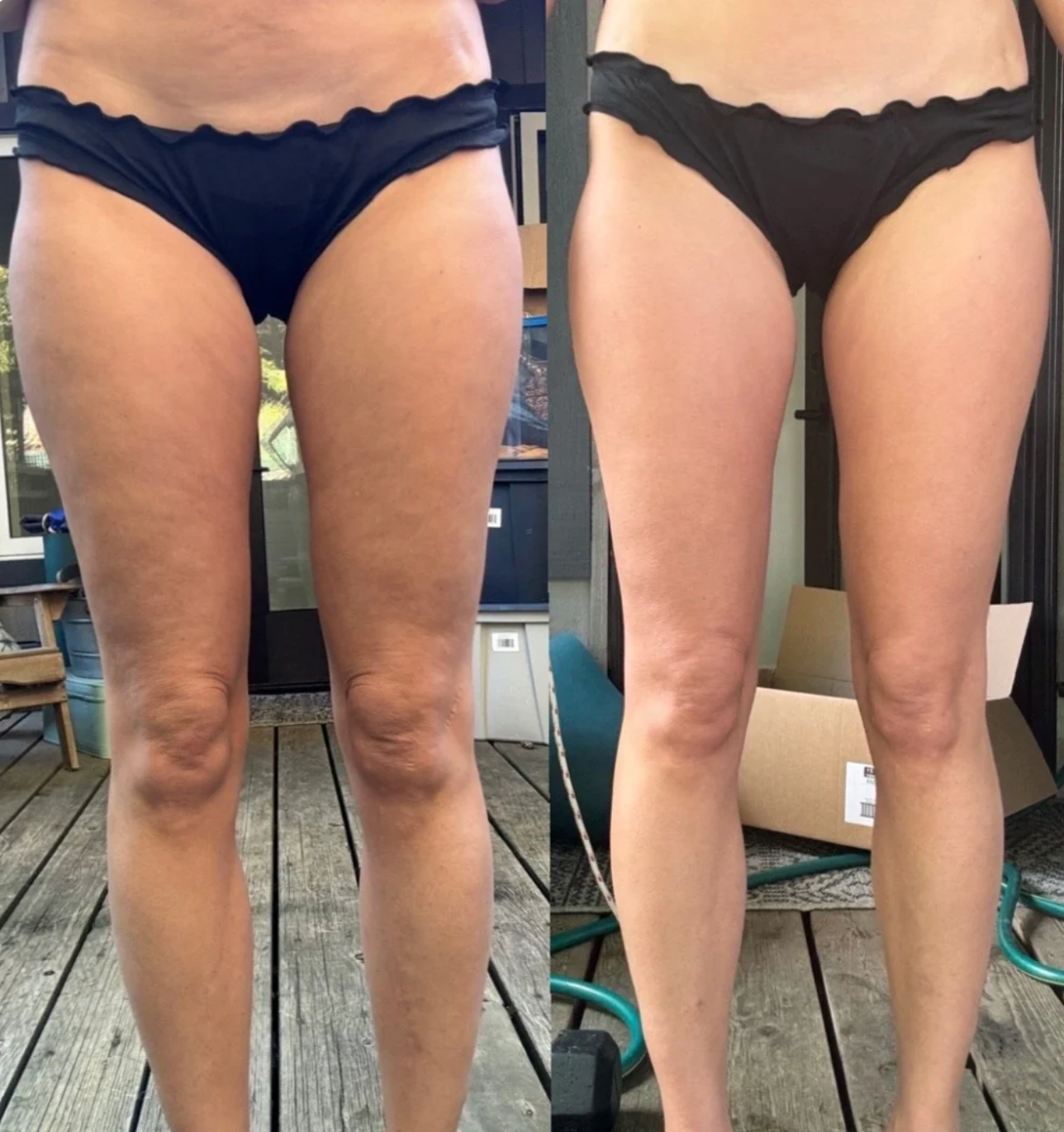 Serenosole™ CellaGlow Anti Cellulite Massagegerät | Für eine glattere Haut und zur Verbesserung der Durchblutung | SchlankSculpt 2024 (+GRATIS Massageöl)