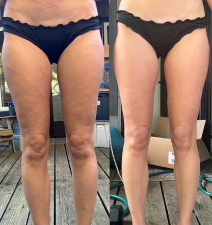Serenosole™ CellaGlow Anti Cellulite Massagegerät | Für eine glattere Haut und zur Verbesserung der Durchblutung | SchlankSculpt 2024 (+GRATIS Massageöl)